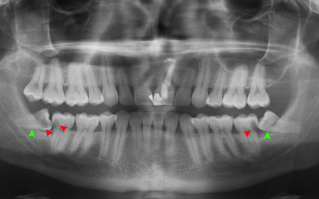 Panoramic X-Rays: A Comprehensive View of Your Oral Health