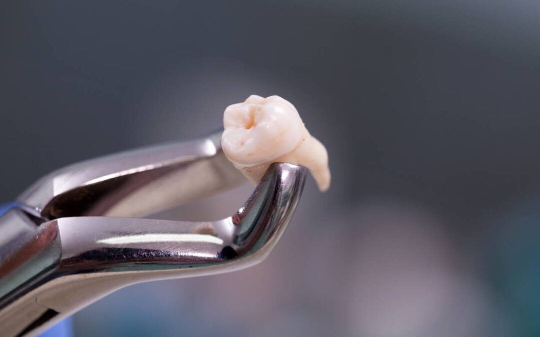 Wisdom Teeth Extractions: Ensuring Optimal Oral Health