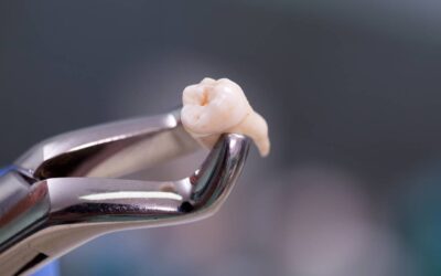 What to Expect After Wisdom Tooth Removal